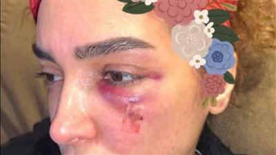 أصيبت الفنانة المصرية، روجينا، أثناء تصوير مسلسلها “بنت السلطان”، 