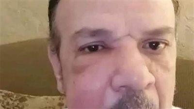 أحمد سلامة يفاجئ متابعيه بصورة توضح تورم وجهه