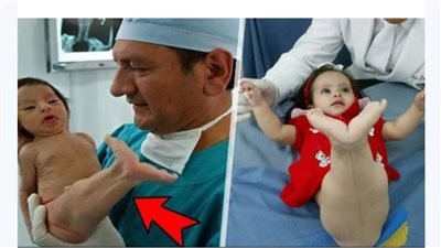 سخـروا من هذه الطفلة لأنها ولدت تشبه حورية البحر…بعد 5 سنوات صدموا كيف أصبحت 