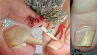 علاج فطريات الأظافر بالزيوت الأساسيةالقائمة