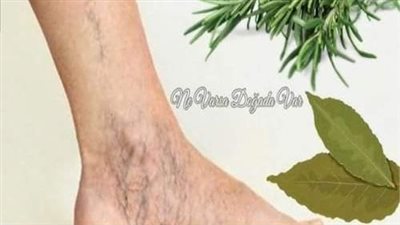 رائع! تخلص من الدوالي بمكونات في مطبخك! كنز يجب أن يمتلكه كل بيت