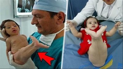 سخـروا من هذه الطفلة لأنها ولدت تشبه حورية البحر…بعد 5 سنوات صدموا كيف أصبحت