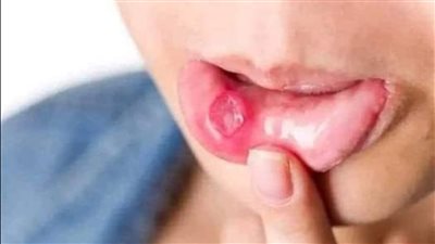 في الشتاء تنتشر قرح الفم بين الناس اليك طريقة علاجها في نصف ساعة فقط فور ظهورها 