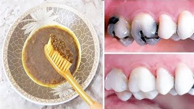 ازالة تسوس الاسنان والجير المتراكم نهائيا بدون حشو وتبيض الاسنان من غير اي جلسات