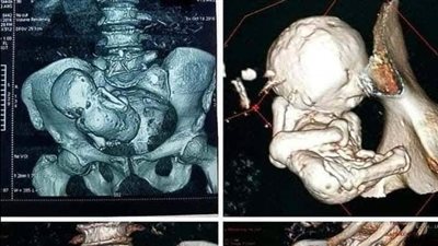 سيدة جـزائرية عندها ٧٣ سنة راحت للدكتور بتشتـكي من شوية ألـم في منطـقة الحـوض