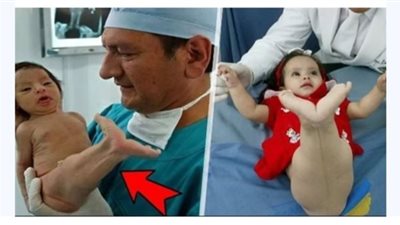 سخـروا من هذه الطفلة لأنها ولدت تشبه حورية البحر…بعد 5 سنوات صدموا كيف أصبحت