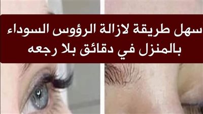 طرق إزالة الرؤوس السۏداء طبيعيًا  