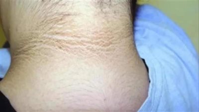 كثير من الأشخاص يعانون من اسوداد في منطقة الرقبة والمنطقة المحيطة بها