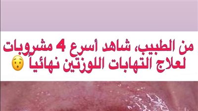 التهاب اللوزتين: الأعراض، والعلاج والأسباب 