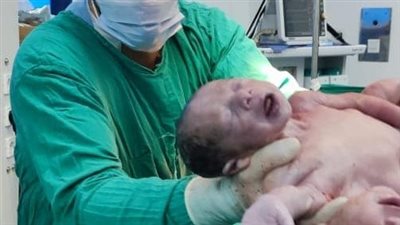 مستشفى چامعة المنصورة تنجح في ولادة توأم ملتصق